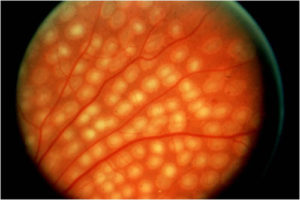 Laser treatment visual