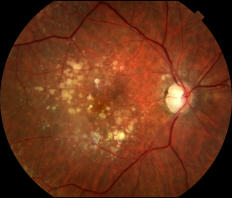 Age related macular degeneration