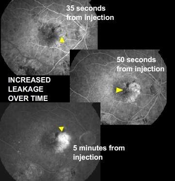 wet amd visual