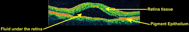 Central Serous Chorioretinopathy visual