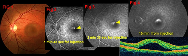 Central Serous Chorioretinopathy graph