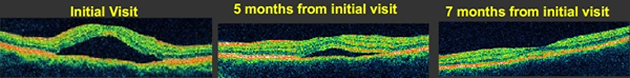 Central Serous Chorioretinopathy visual