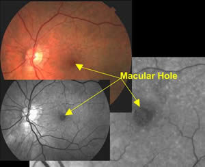 Macular hole visual