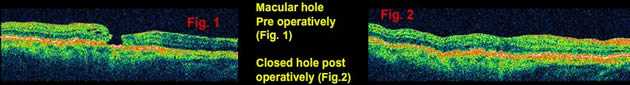 Macular hole treatments
