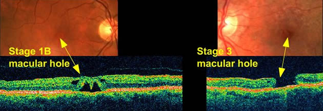 Macular Hole symptoms visual