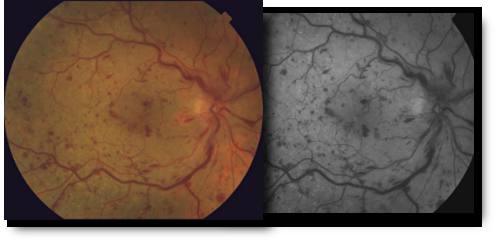 Retinal Vascular Occlusion visual